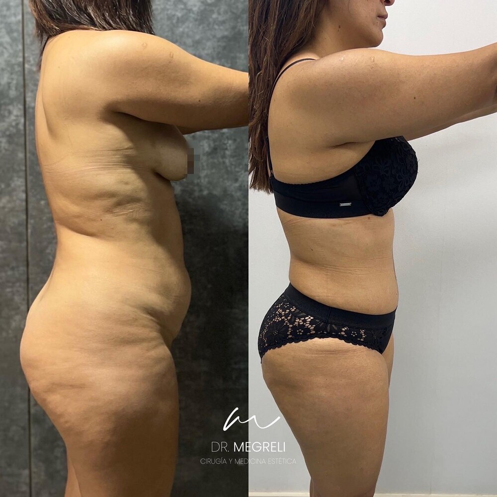 Before and After Result